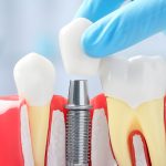 dental implant system