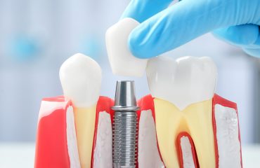 dental implant system